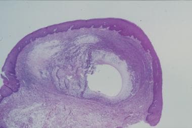 mucocele histology