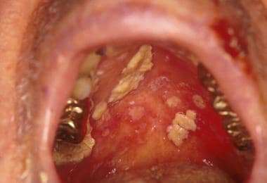 Oral pseudomembranous candidiasis on the hard pala