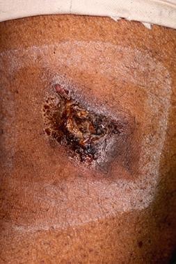 An isolated lesion of calciphylaxis manifesting as