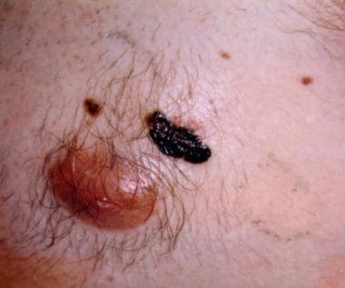 superficial spreading melanoma stages