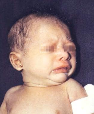A newborn boy with anhidrotic/hypohidrotic ectoder