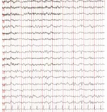 EEG in a 56-year-old man with uremic encephalopath