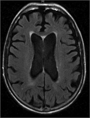 This image shows cortical atrophy, which is the de
