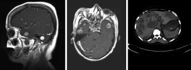 Multiple brain metastasis in a patient with known 