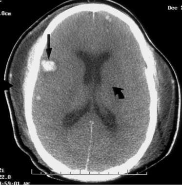 Head CT shows small intracerebral hemorrhage foci 
