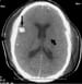 Meningococcal Meningitis