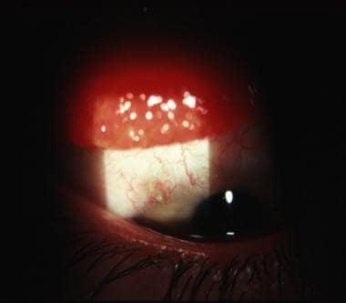 giant papillary conjunctivitis symptoms