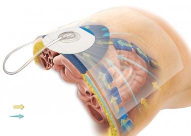 Temporary Abdominal Closure Techniques: Background, Abdominal Compartment  Syndrome: Etiology and Pathophysiology, Abdominal Compartment Syndrome:  Prevention and Treatment