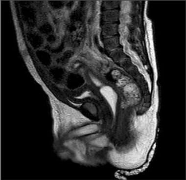 MRI demonstrating uterus and vagina in a 46XY infa