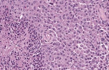 This glioblastoma is composed of large epithelioid