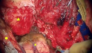 After gross total resection of the tumor (star = o