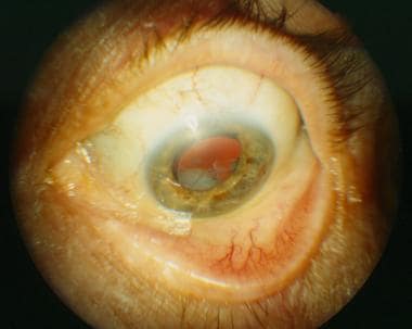 Patient with persistently elevated intraocular pre