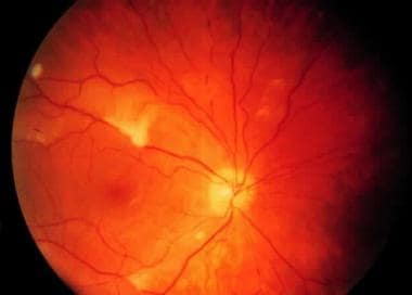 Purtscher-like retinopathy in a patient with syste
