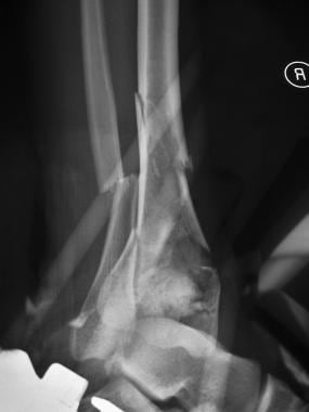 Lateral view of pilon fracture. 