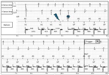 Pacemaker-Mediated Tachycardia. Example of a PMT i