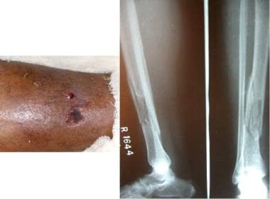 Diaphyseal tibial fracture. Clinical and radiograp