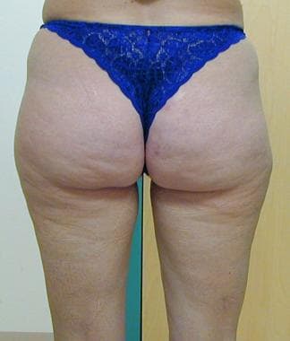 Liposuction, trunk. Posterior view of patient befo