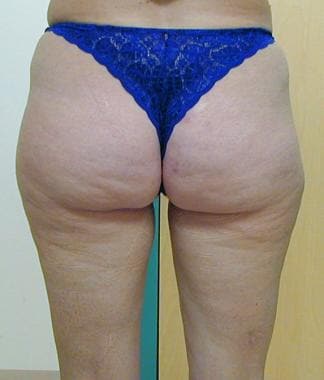 Visible scar tissue hard lump after inner thigh lipo 2 months ago