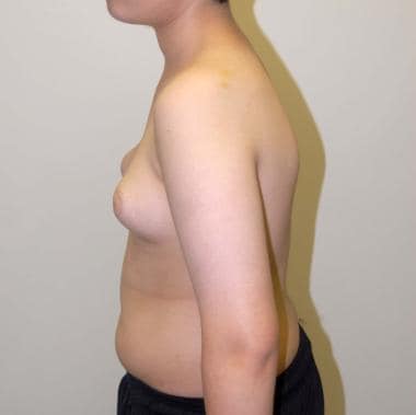 A 16-year-old patient with adolescent gynecomastia