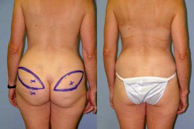 Breast Reconstruction: Gluteal Artery Perforator (GAP) Flap
