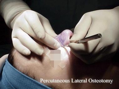 Percutaneous lateral osteotomy. 
