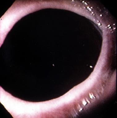 Schatzki Ring. Endoscopic appearance of the distal