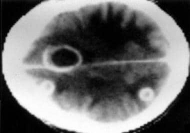 CT scan of a brain abscess. 