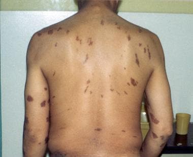 Epidemic Kaposi sarcoma (KS). Large violaceous tru