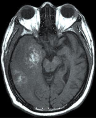 A T1-weighted axial MRI without intravenous contra