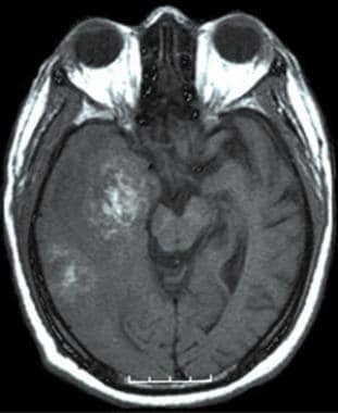 没有静脉注射的T1加权轴向MRI