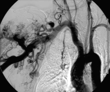 Hypertrophied subclavian artery resulting from low