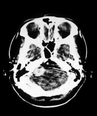 CT扫描患者，具有大型声学神经瘤