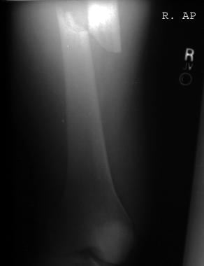 Anteroposterior radiograph of a femur fracture in 