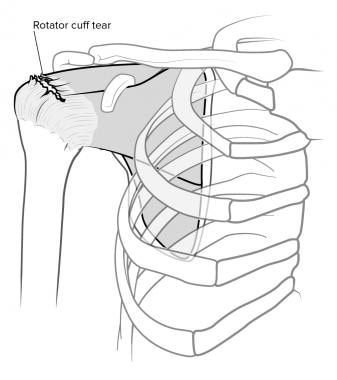 Rotator cuff tear