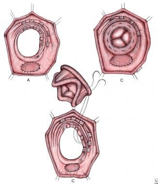 Surgical replacement of the tricuspid valve in Ebs
