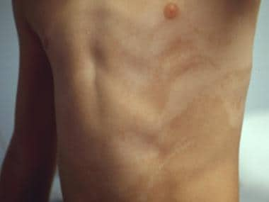 Hypomelanosis of Ito on the torso. 