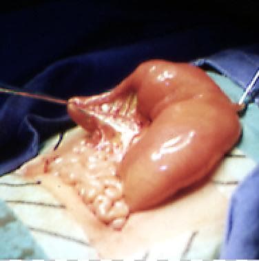 Pediatric Small Bowel Obstruction. The surgical im