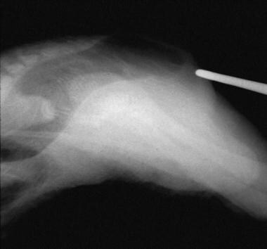 Cross-fire radiograph in which air column in dista