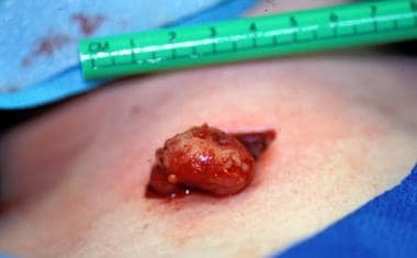A lymph node after removal by means of biopsy, whi