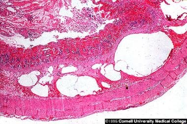 Histologic section of mucosal wall demonstrating p