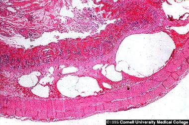 necrotizing enterocolitis histology