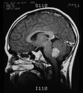MRI showing a medulloblastoma of the cerebellum. 