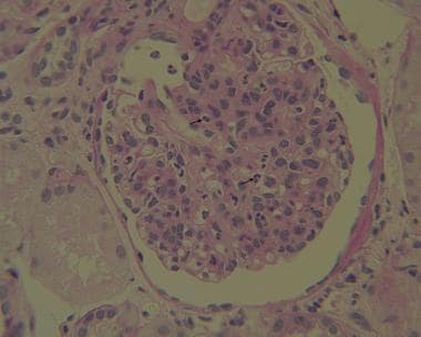 Kidney biopsy from a 7-year-old child with acute p