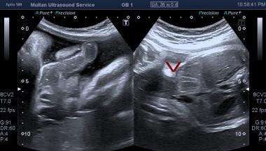 Intrauterine blood clot  Radiology Reference Article