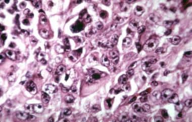 Choroidal melanoma. Histologic section showing epi