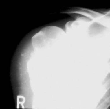 Anteroposterior radiograph of a periosteal chondro