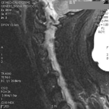 T2-weighted MRI of cervical disk herniation. 