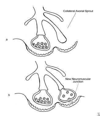 The development of extrajunctional acetylcholine r