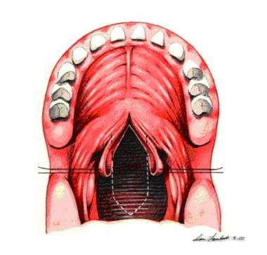 Soft palate flaps are retracted. 
