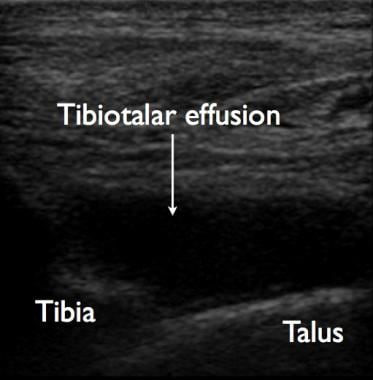 Ultrasonographic image of a tibiotalar joint effus